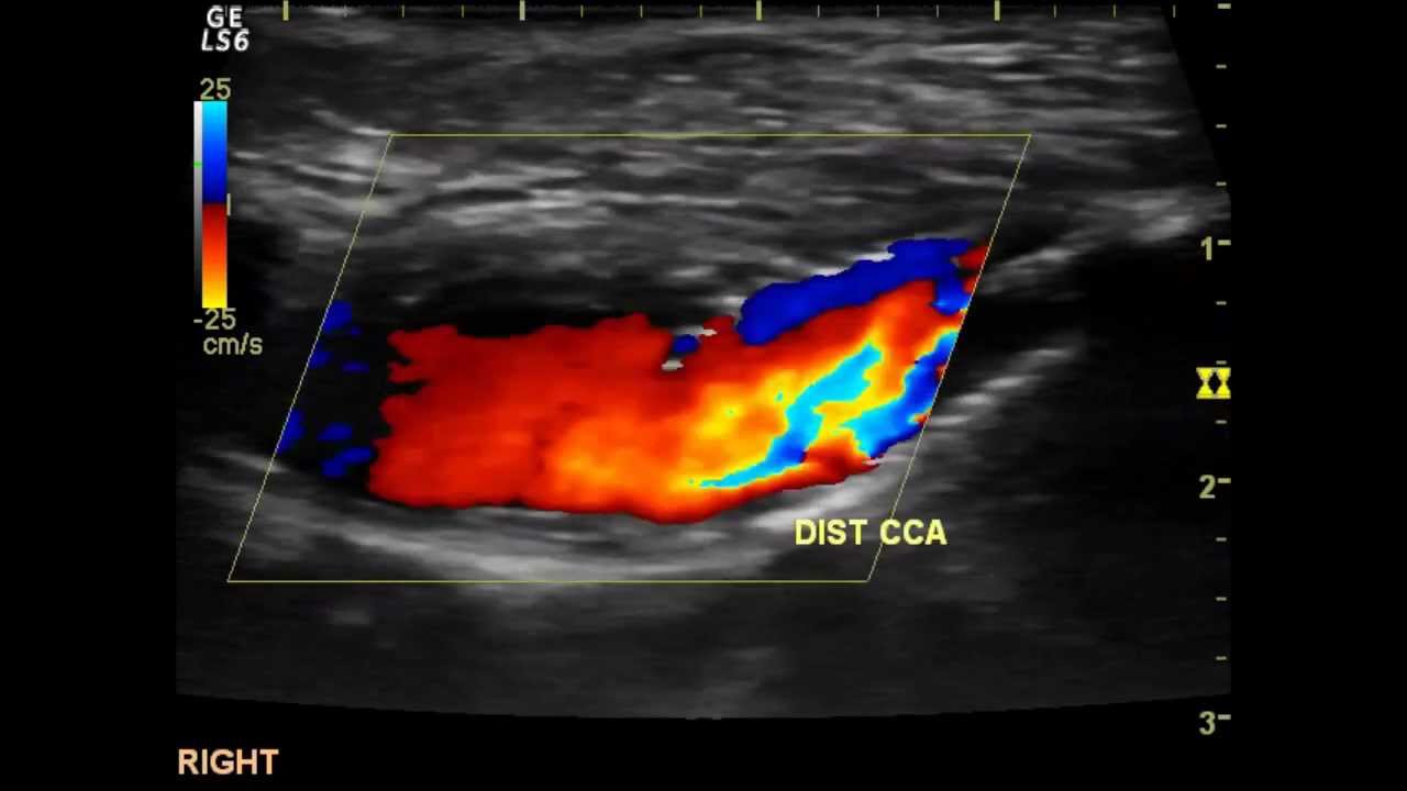 Echo color doppler