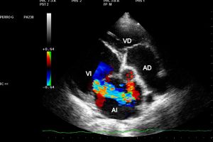 Echocardiogram