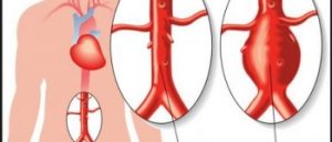 Aneurysm or steno obstruction of the abdominal aorta